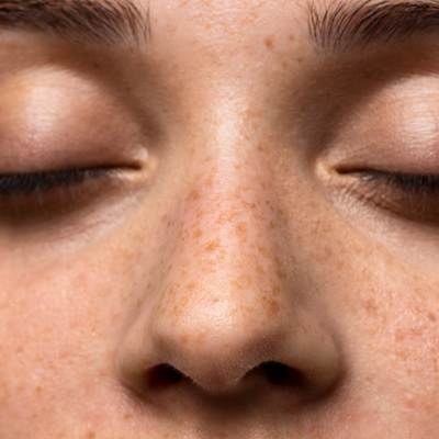 Pigmentation