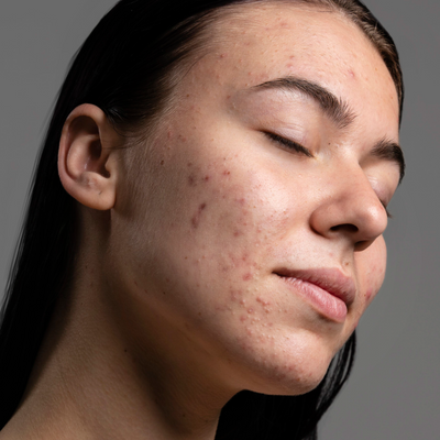 Acne