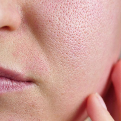 Open Pores