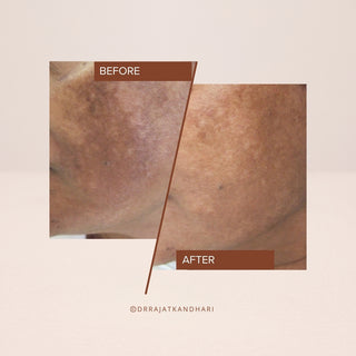 Before and after results using FaceCraft Exfoliate serum  - visible reduction in dark spots and improved skin tone.