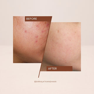 Before and after results using FaceCraft Exfoliate serum - visibly smoother and brighter skin