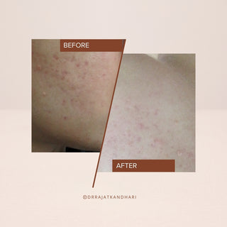 Before and after results showing reduced redness and acne after using FaceCraft Clean gentle cleanser - dermatologist crafted formula with Niacinamide and Lactic acid