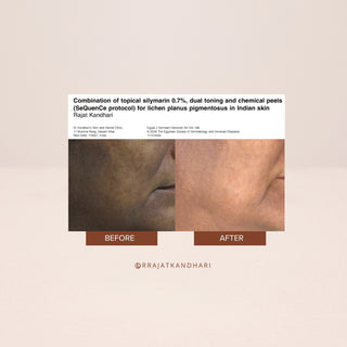 FaceCraft Restore retinol night cream before and after results - visible reduction in pigmentation, wrinkles and uneven skin tone. 