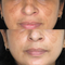 Dark Spot Correction